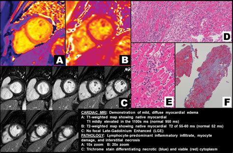 STEROID-RESPONSIVE FULMINANT LYMPHOCYTIC MYOCARDITIS MIMICKING GIANT-CELL MYOCARDITIS | JACC