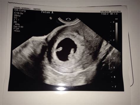 7 week ultrasound twins? (Photo) - Page 2 | BabyCenter