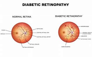 Image result for retinopathies