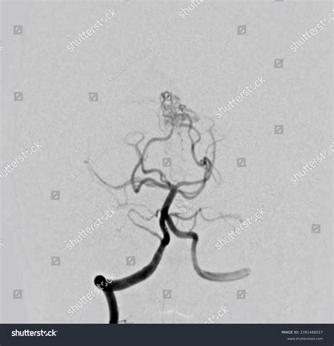 Cerebral Angiogram Medical Imaging Procedure Used Stock Photo ...