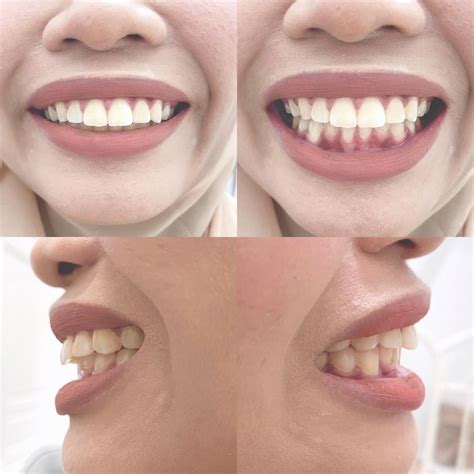 Braces off after 3 years 9 months 35 days. Braces was done without an ...