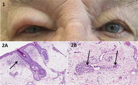 Melkersson-Rosenthal Syndrome Presenting as Isolated Eyelid Edema - Ophthalmology