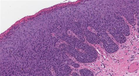Squamous dysplasia | MyPathologyReport