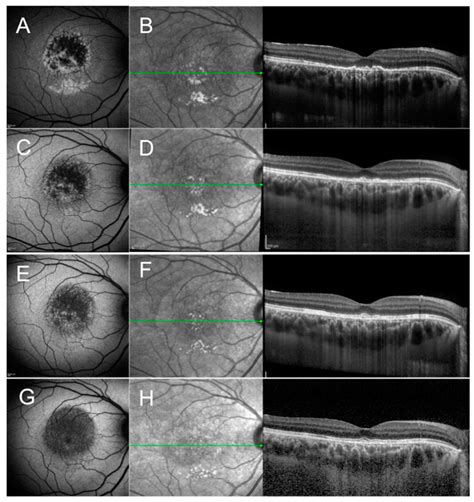 Central Serous Retinopathy Differential Diagnosis
