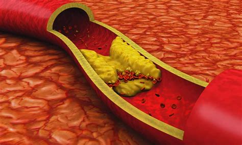 Intensive LDL-C Targeting Enhances Clinical Outcomes in CVD: NEJM