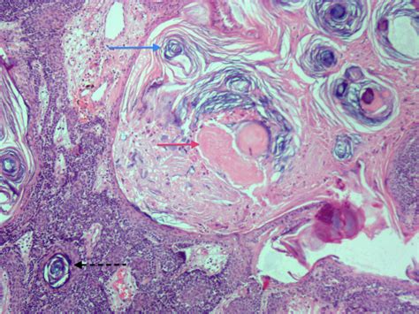 Dermatopathology Society of India