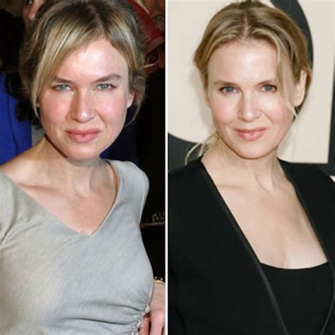 Cosmetic surgery new look renee zellweger now 323998-Renee zellweger cosmetic surgery