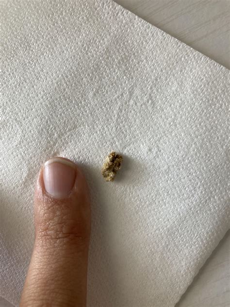 Was just told I have about 3mm stone in right kidney. What can I do? : r/KidneyStones
