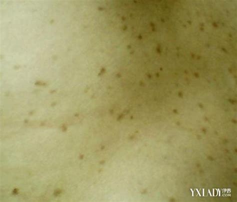 咖啡斑（cafe-au-lait spots）症状表现 - 皮肤病学 - 天山医学院