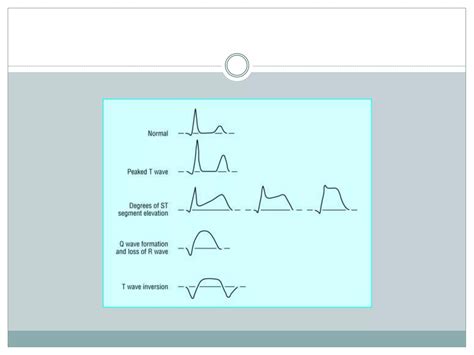 Interpretation of common ecg abnormalities | PPTX