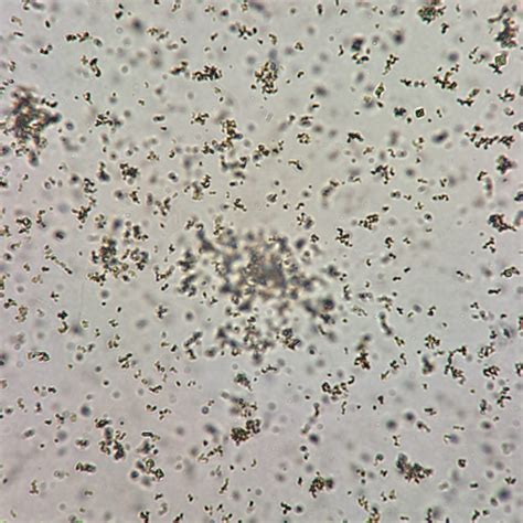 Urinary Crystals: Identification & Clinical Significance