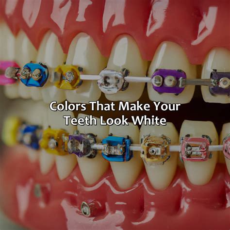 What Color Braces Make Your Teeth Look White - colorscombo.com