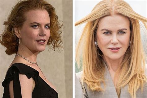 Nicole Kidman Plastic Surgery Before And After Pictures