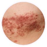 Penvir - Famciclovir, Antiviral Medicine for Shingles and Genital Herpes