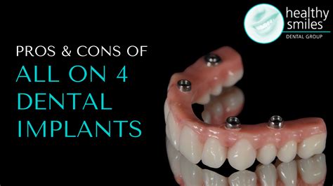 Pros And Cons Of Dental Implants Vs Partials at Cody Chapple blog