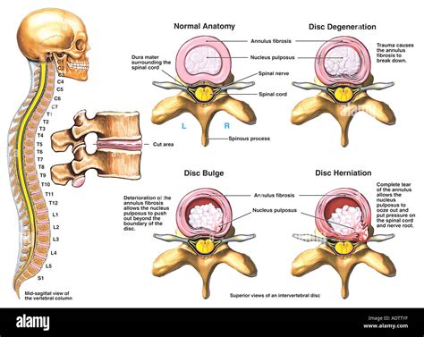 Degenerative disc disease hi-res stock photography and images - Alamy