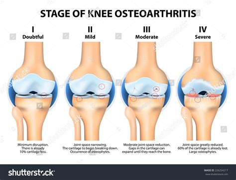 Stages Of Knee Osteoarthritis (Oa). Kellgren And Lawrence Criteria For Assessment Stage Of ...