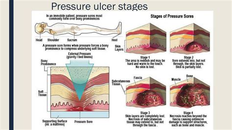 PPT - Pressure Sore Prevention PowerPoint Presentation, free download ...