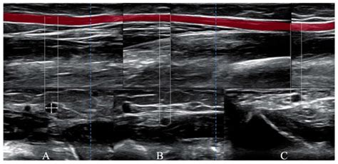 Impact of the Use of a Larger Forearm Artery on the Efficacy and Safety ...