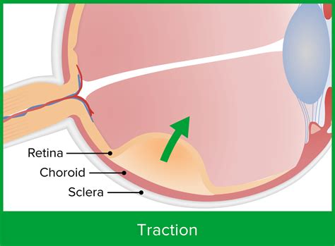 Retinal Detachment | Concise Medical Knowledge