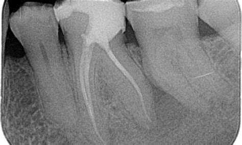 Clinical Case Collection | TruNatomy | Dentsply Sirona India