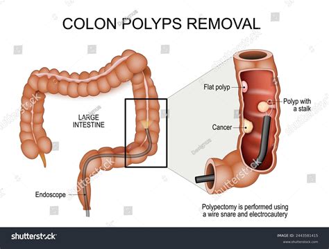 Colon Polyp Removal
