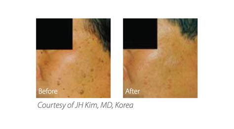 Action II | Leader Healthcare India