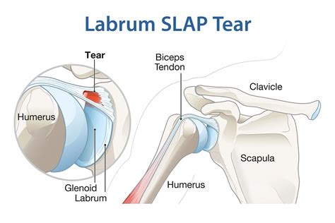 What Is A Labrum