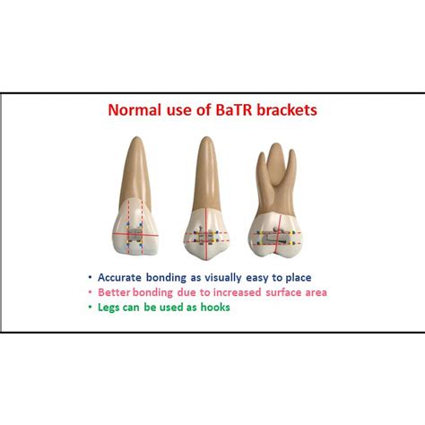 BaTR MBT Metal Brackets with Variable Torque & Rotation – Dentalmantraa