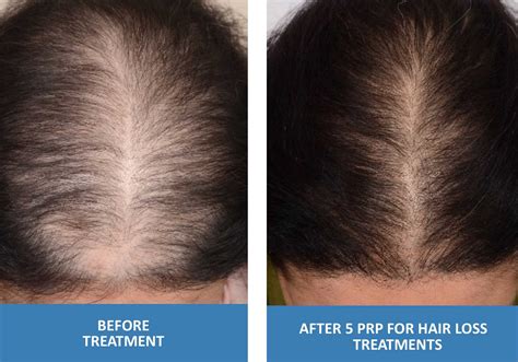 Prp Hair Loss