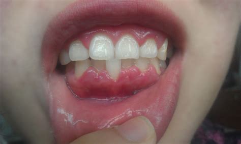 牙龈红肿、牙龈出血、口臭，一定不能忽视！-爱康健齿科