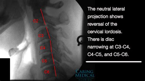 Reversal Of Cervical Lordosis