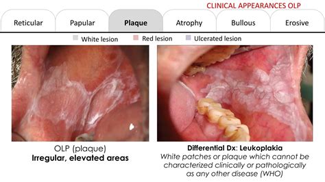 Oral Lichen Planus | PDF