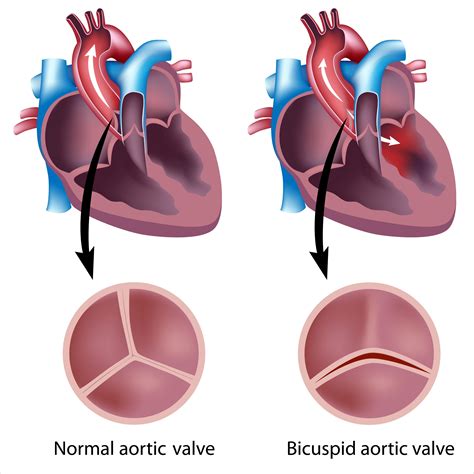 Unicuspid Aortic Valve