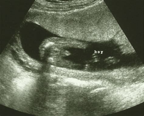 Baby Boy In Ultrasound 20 Weeks at Shawn Keim blog