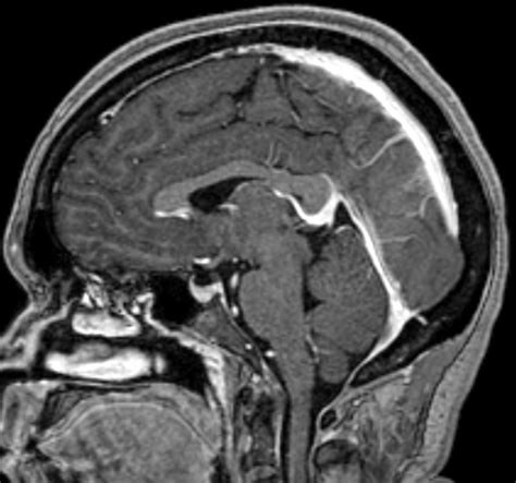 Inferior Sagittal Sinus