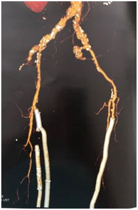 Technique and early results of percutaneous femoropopliteal bypass with stent graft - Journal of ...
