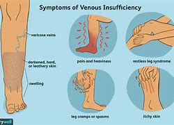 Image result for Venous
