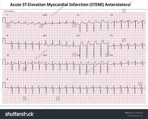 Lateral Myocardial Infarction Ecg