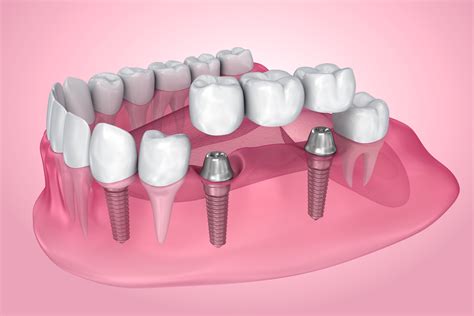 The Pros and Cons of Dental Implants - Saskatoon Smiles