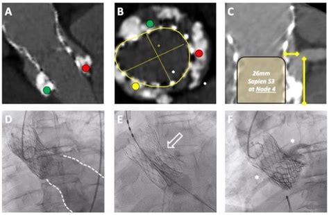 Transcatheter Aortic Valve Implantation to Treat Degenerated Aortic ...