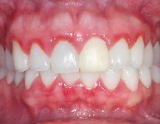 Image result for gingivitis