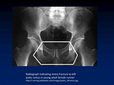 PPT - Pubic Ramus Stress Fractures: Diagnosis and Recovery PowerPoint ...