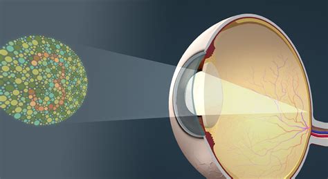 Image result for Colour Vision Deficiency Causes