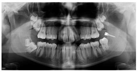 Uprighting Impacted Mandibular Second Molar Using a Skeletal Anchorage ...