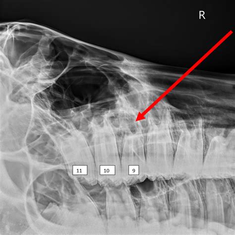 Abscess Tooth X Ray at Shelley Siegel blog