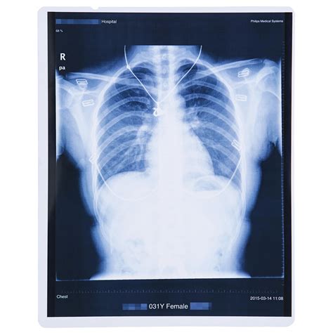 Digital Mammography Inkjet X-ray Medical Films for FUJI Printer - Blue ...