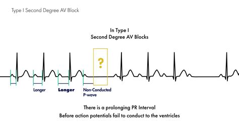 Difference Between First And Second Degree Av Block - Free Word Template