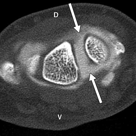 Scapholunate Advanced Collapse and Scaphoid Nonunion Advanced Collapse: MDCT Arthrography ...