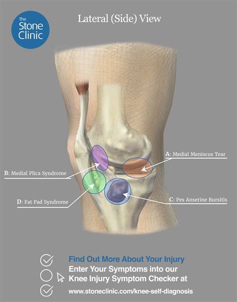 Knee Pain Symptom Checker [Online Knee Injury Self-Diagnosis Tool]